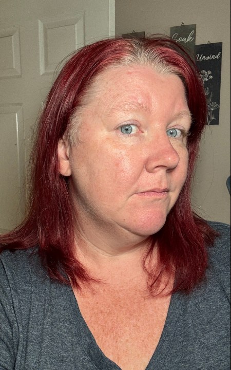 Fine lines before Derma Muse