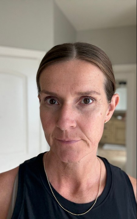 Dry patches and under-eye shadow before Derma Muse
